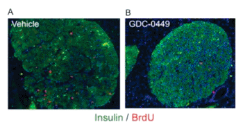 Image: Endocrine Tumor Syndrome. Inhibition of Hedgehog signaling in a MEN1 mouse model results in decreased islet cell proliferation. Immunofluorescence for BrdUrd and insulin in pancreas of Men1-excised mice fed with either vehicle control (left) or Erivedge/GDC-0449 (right) for four weeks at a dose of 100 mg/kg twice daily (Photo courtesy of Dr. Xianxin Hua, and Dr. Buddha Gurung, Perelman School of Medicine, University of Pennsylvania).